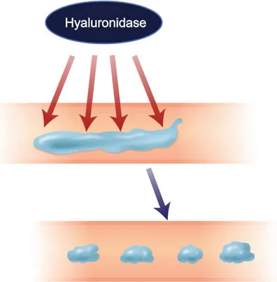 Fig 10. Acción de la hialuronidasa sobre un depósito intravascular de relleno